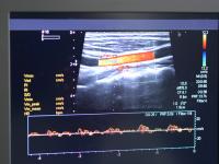 ultrasound image of vein on a computer screen